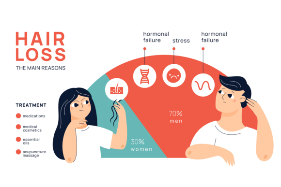 Download Hair Loss Infographic. Male and Female a - Graphic Collection