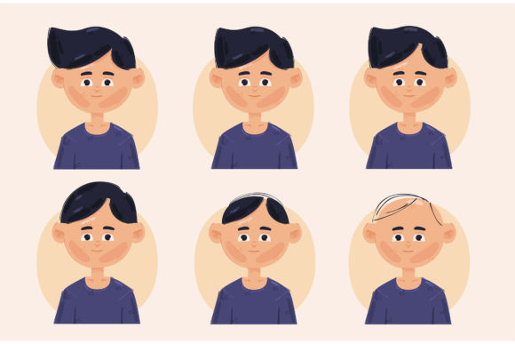 Download Hair Loss Stages Illustration - Illustration Collection